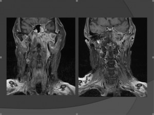 MRI צווארי