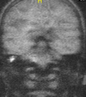 MRI כולסטאטומה