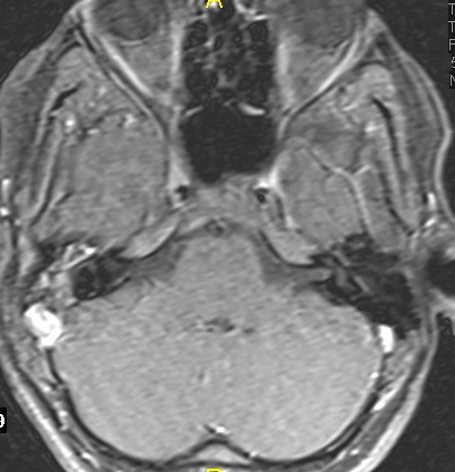 MRI כולסטאטומה