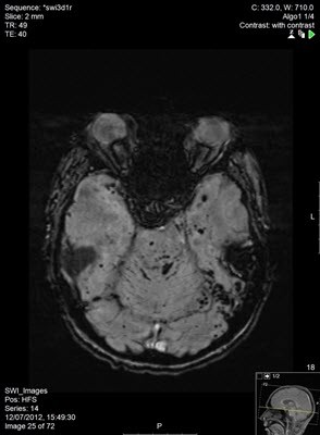 בדיקות MRI ו-CT במקרים של דימומים במוח