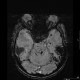 בדיקות MRI ו-CT במקרים של דימומים במוח