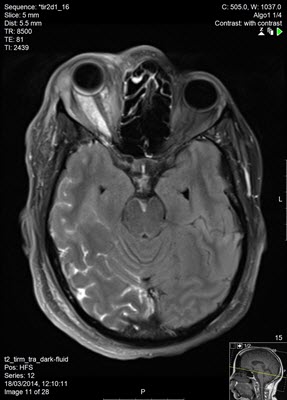 MRI ילדים