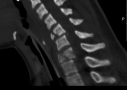 MRI ו CT עמוד שדרה