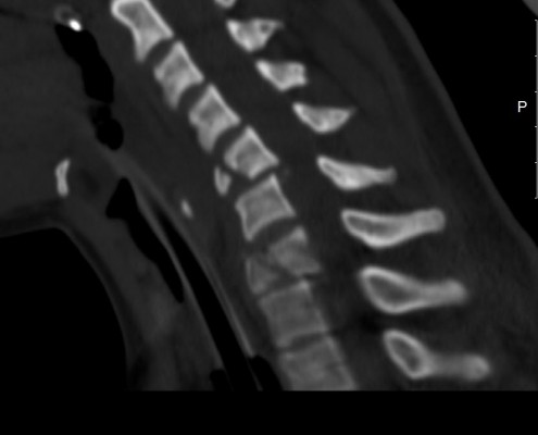 MRI ו CT עמוד שדרה