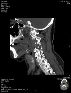 ct scan spine