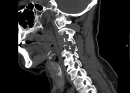 ct scan spine