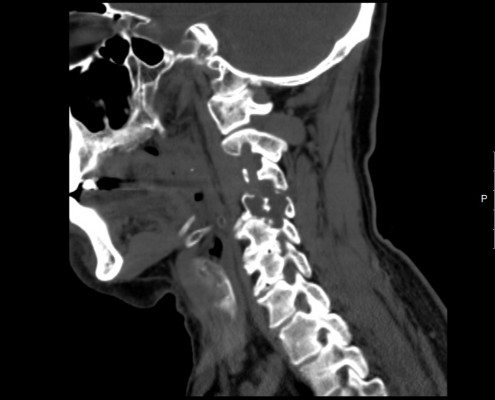 ct scan spine