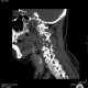ct scan spine