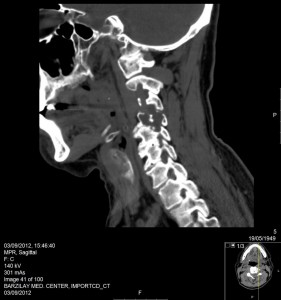 ct scan spine 63 year old man