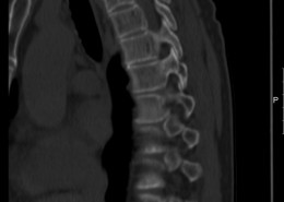 ct scan of spine 60 year old man