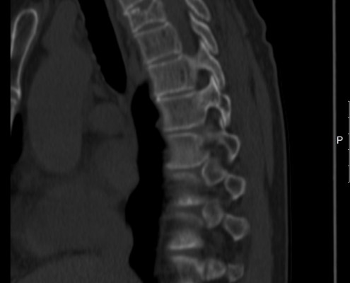 ct scan of spine 60 year old man