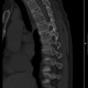 ct scan of spine 60 year old man