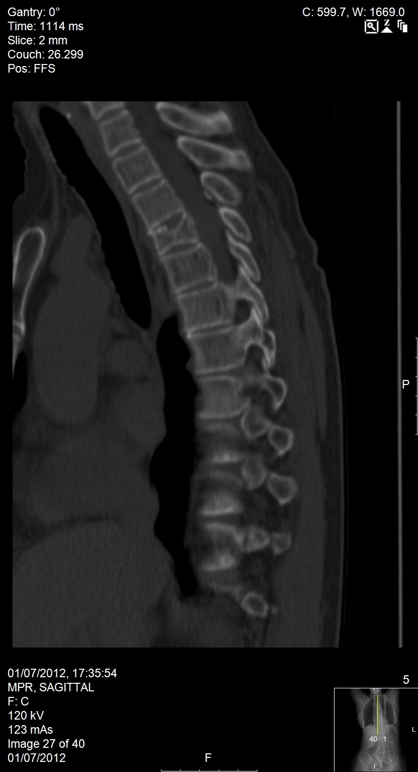 ct scan of spine 60 year old man