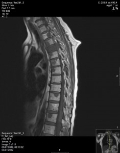 mri test 60 year old man spine