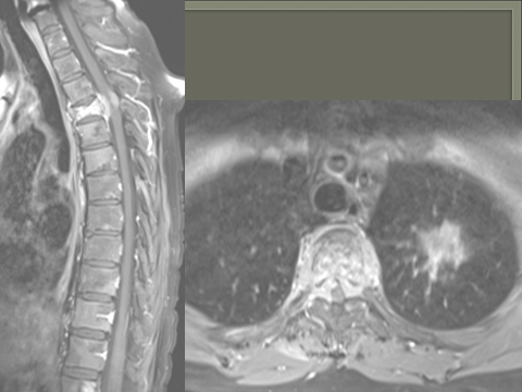 mri lungs 60 year old man