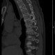 st scan of spine