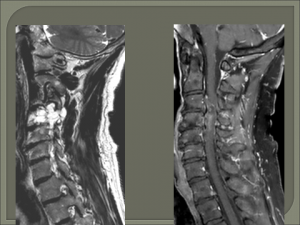 mri test spine