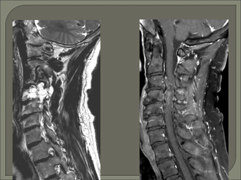 mri test spine