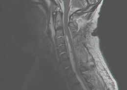 limb weakness mri test spine