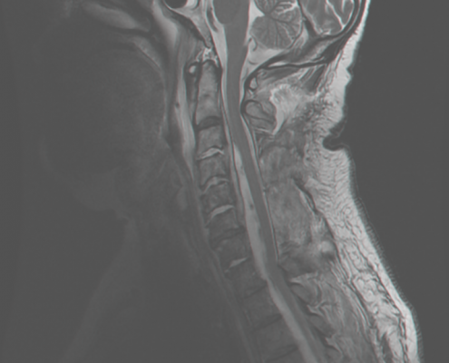 limb weakness mri test spine