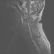 limb weakness mri test spine