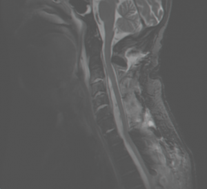 spinal mri test of 60 year old woman