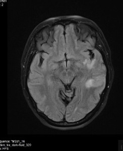 MRI מוח