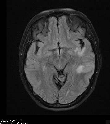 MRI קריש חוסם