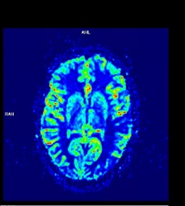 הוצאת קריש חוסם בדיקת MRI