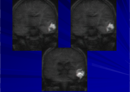 mri ears cholesteatoma 2