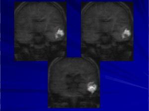 בדיקת MRI לטיפול בכולסטאטומה באוזניים