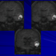 mri ears cholesteatoma 2