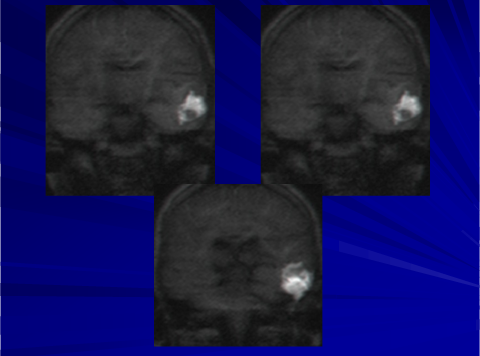 mri ears cholesteatoma 2