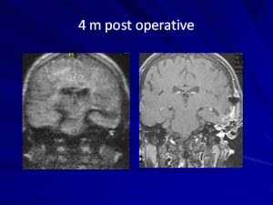 mri ears cholesteatoma