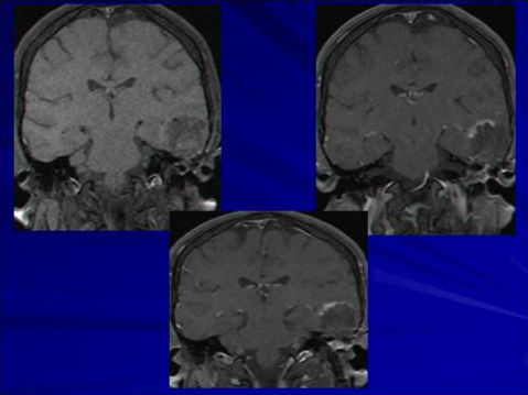 mri showing ears cholesteatoma