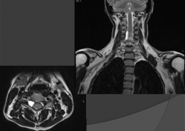MRI test - spine