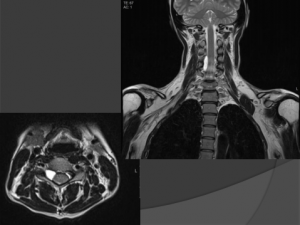 MRI test - spine