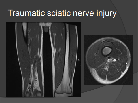 mri test shows Traumatic sciatic nerve injury