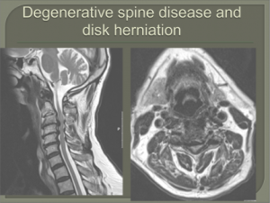 בדיקת MRI עמוד שדרה