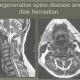 בדיקת MRI עמוד שדרה