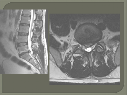 MRI spine waist disk