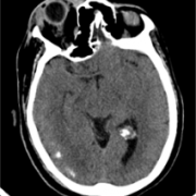 ct Blood vessels in eye sockets