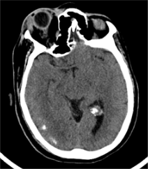 ct Blood vessels in eye sockets
