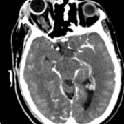 Blood vessels in eye sockets - ct