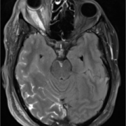 mri Blood vessels in eye sockets