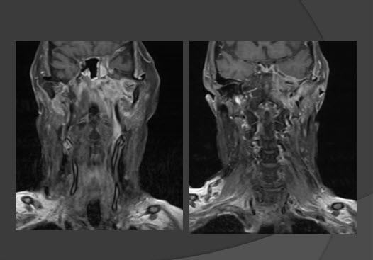 neck tumor showing on mri