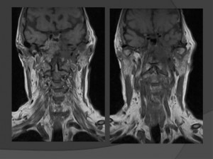neck tumor showing on the left side