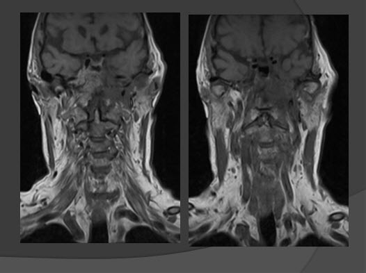 neck tumor showing on the left side